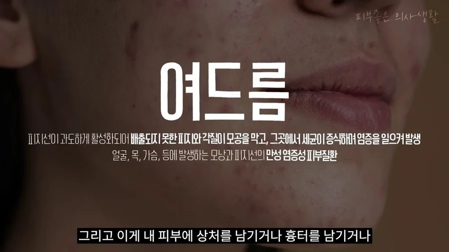 여드름을 피지선이 과하게 활성화되어 생기는 만성 염증성 피부질환으로 설명한 화면