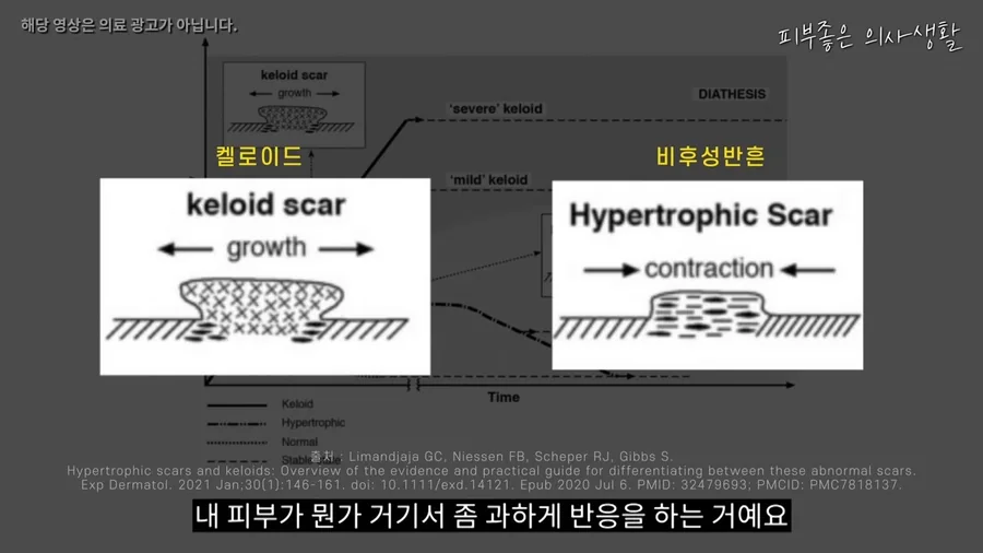 옆으로 자라 나가는 켈로이드와 상처 안에서 수축하며 두꺼워지는 비후성 반흔을 비교한 그림