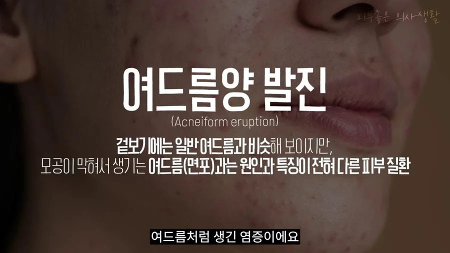 겉보기에는 일반 여드름과 비슷하지만 원인과 특징이 다른 여드름양 발진을 설명한 화면