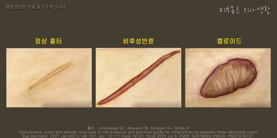 정상 흉터, 비후성 반흔, 켈로이드를 나란히 그려 차이를 보여 주는 그림