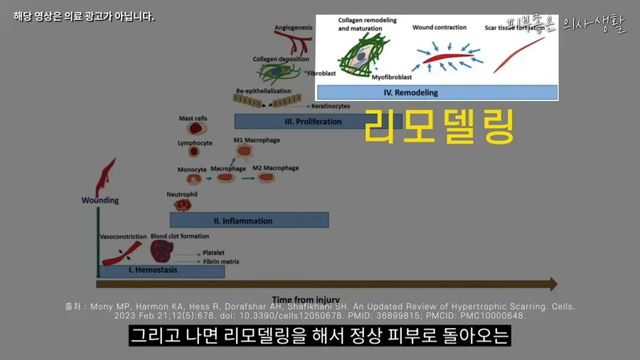 상처가 생긴 뒤 지혈, 염증, 증식, 리모델링 순서로 회복되는 과정을 그린 그림